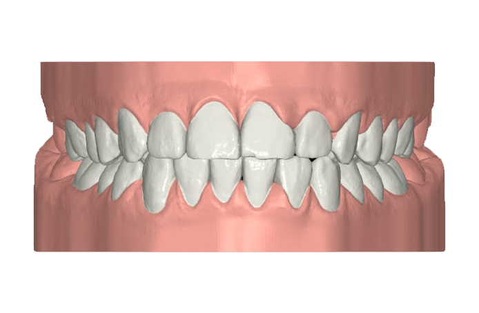 diastema_dopo