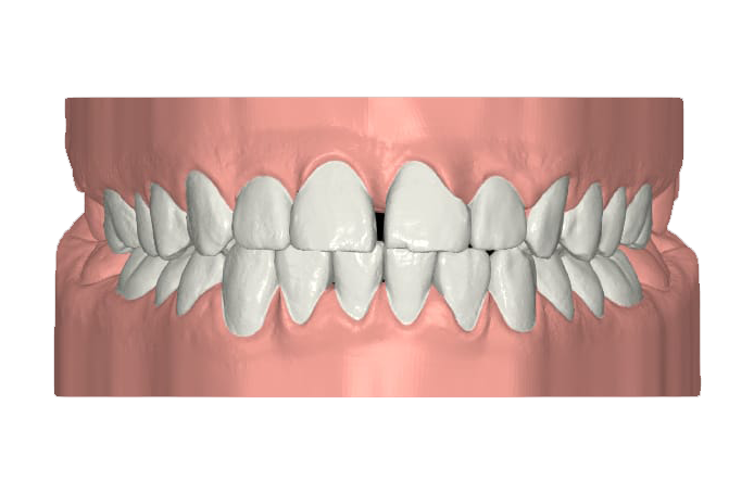 diastema_prima diastema_prima